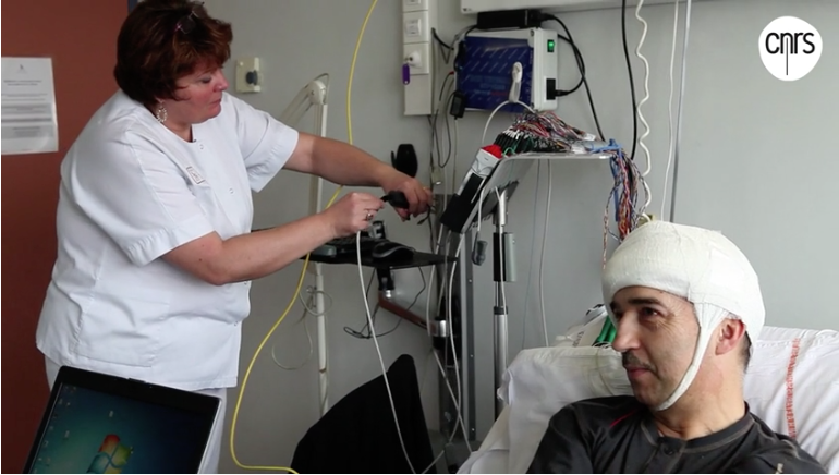 SEEG sur patient épileptique implanté (photo : CNRS)