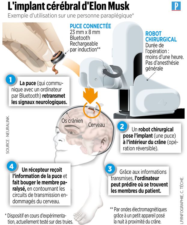 The Link, l'implant cérébral d'Elon Musk, et le robot chirurgical qui permettra de l'implanter (infographie : Le Parisien, 2020)