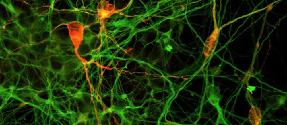 Cellules neuronales dopaminergiques immatures dérivées de cellules iPS (Asuka Morizane, Center for iPS Cell Research and Application, Kyoto University)