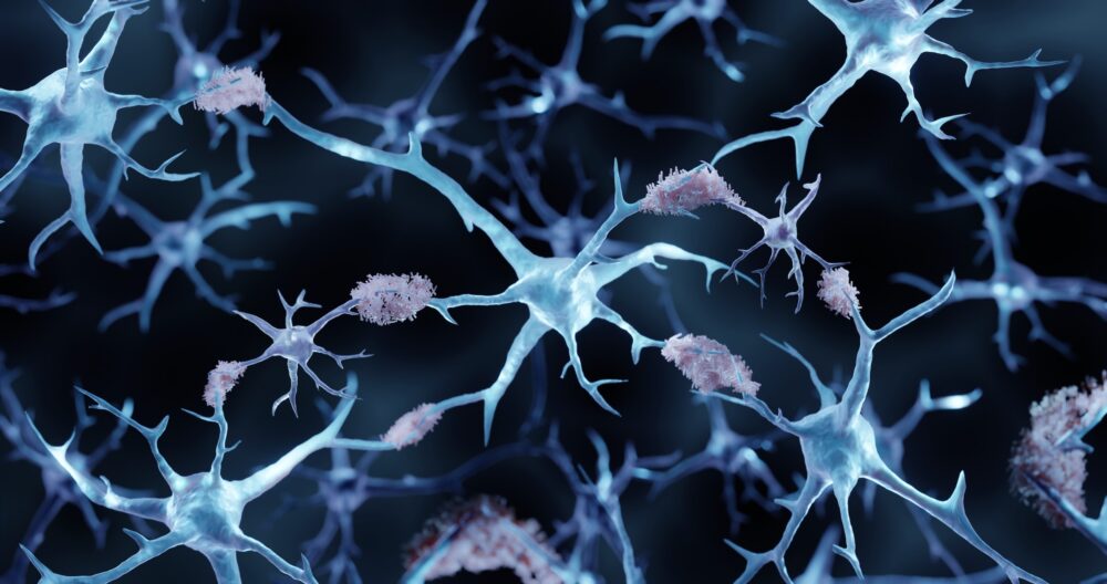 Maladie d’Alzheimer : les biomarqueurs sanguins en passe de révolutionner le diagnostic ©Shutterstock/ART-ur